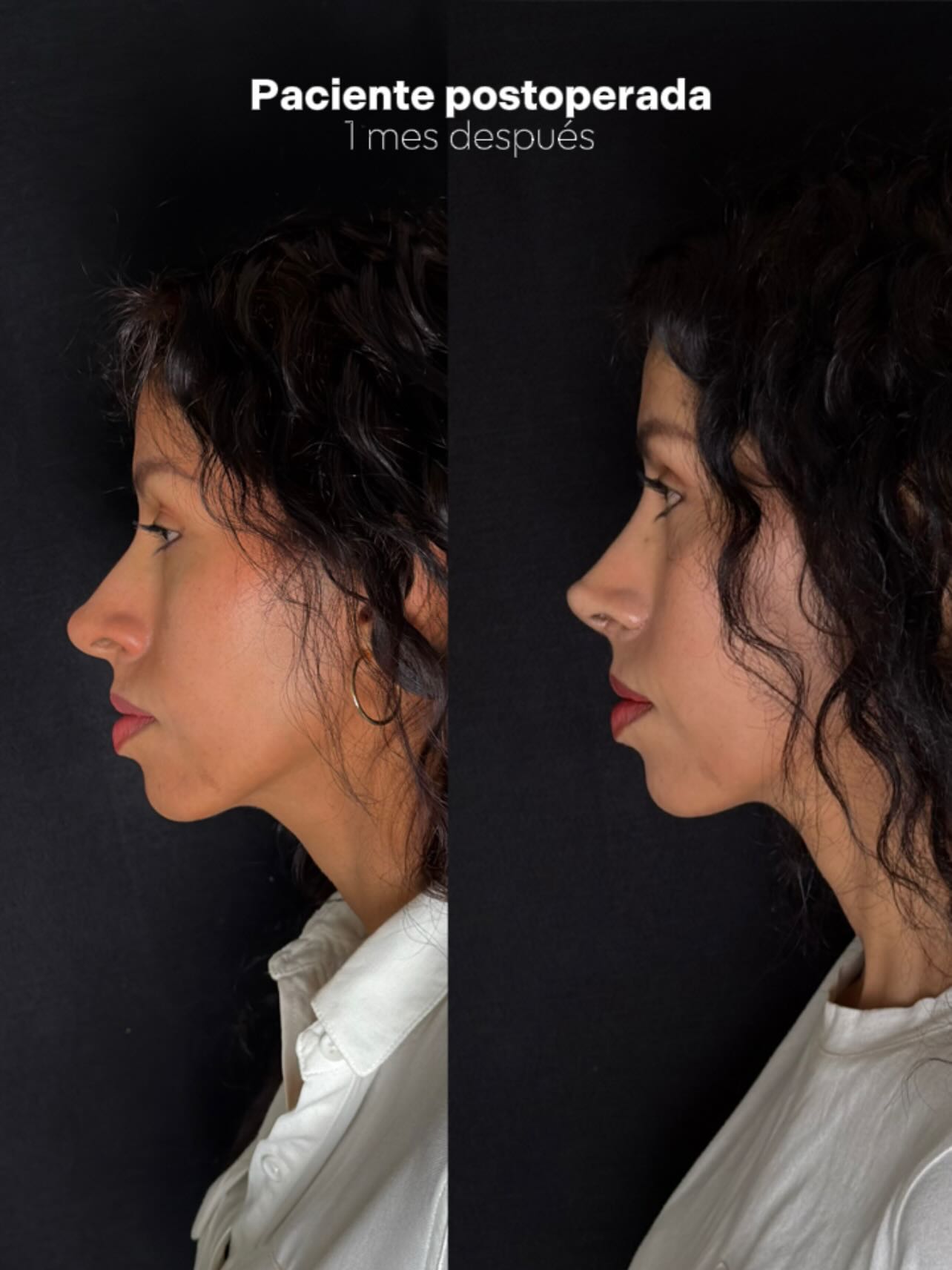 Caso 3 — resultado de rinoplastia