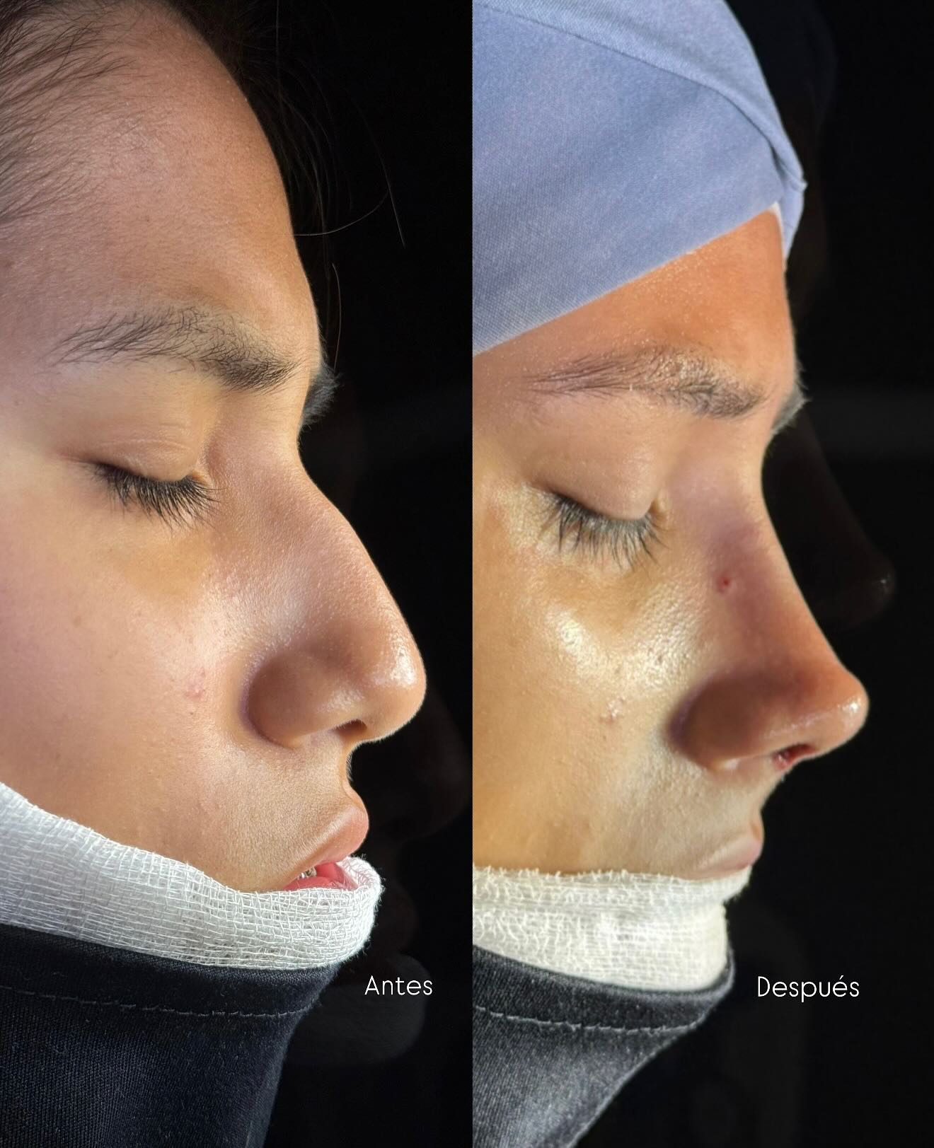 Caso 4 — resultado de rinoplastia