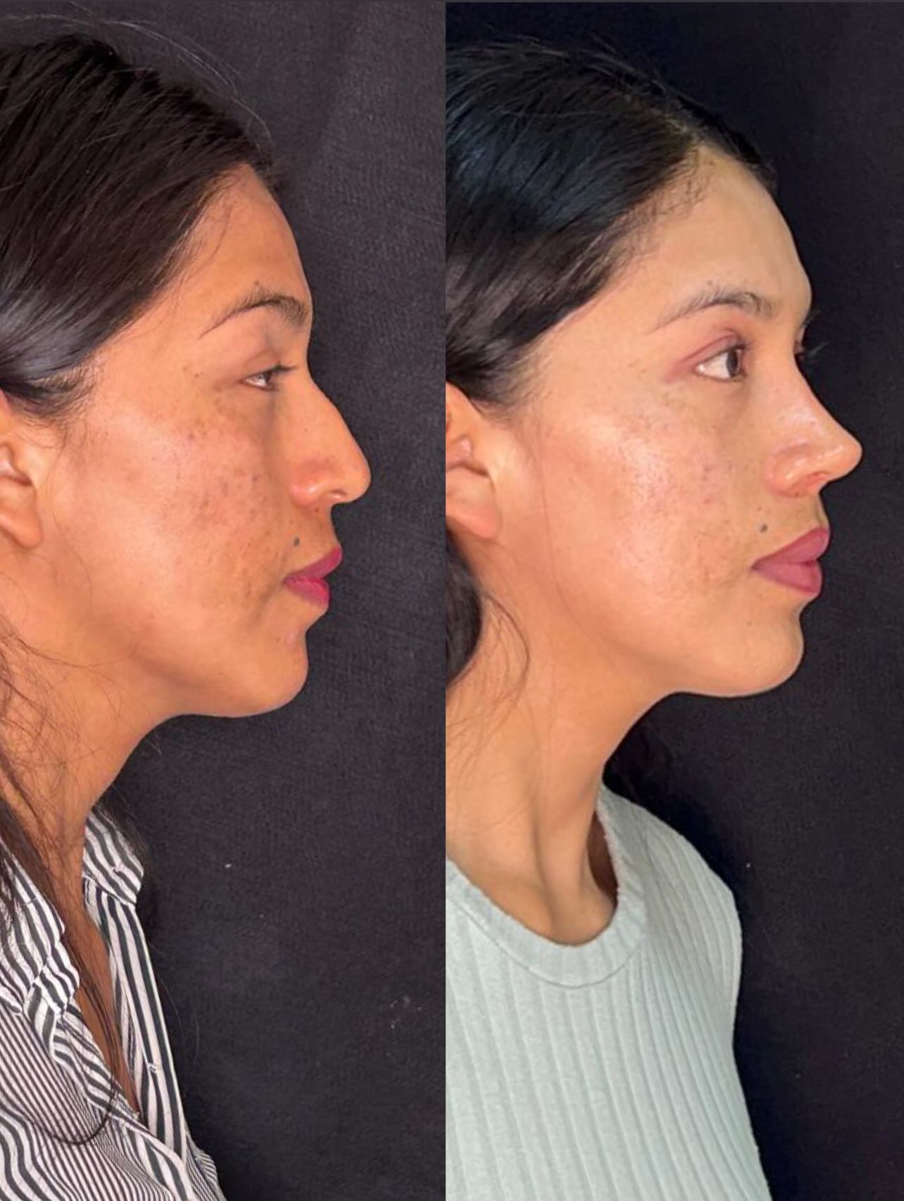 Caso 8 — resultado de rinoplastia